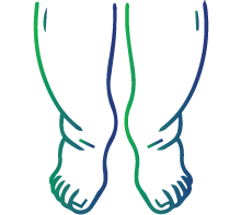 Swelling in the legs and ankles