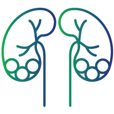 Development of kidney stones
