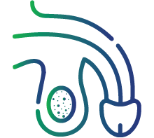 Hydrocele (fluid build-up in the scrotum)