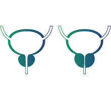 Benign prostatic hyperplasia (Enlarged prostate)