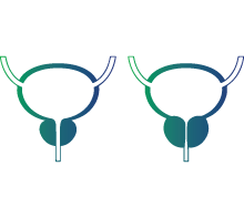 Benign prostatic hyperplasia (Enlarged prostate)