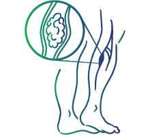 Deep vein thrombosis (blood  clot in deep veins of the legs)