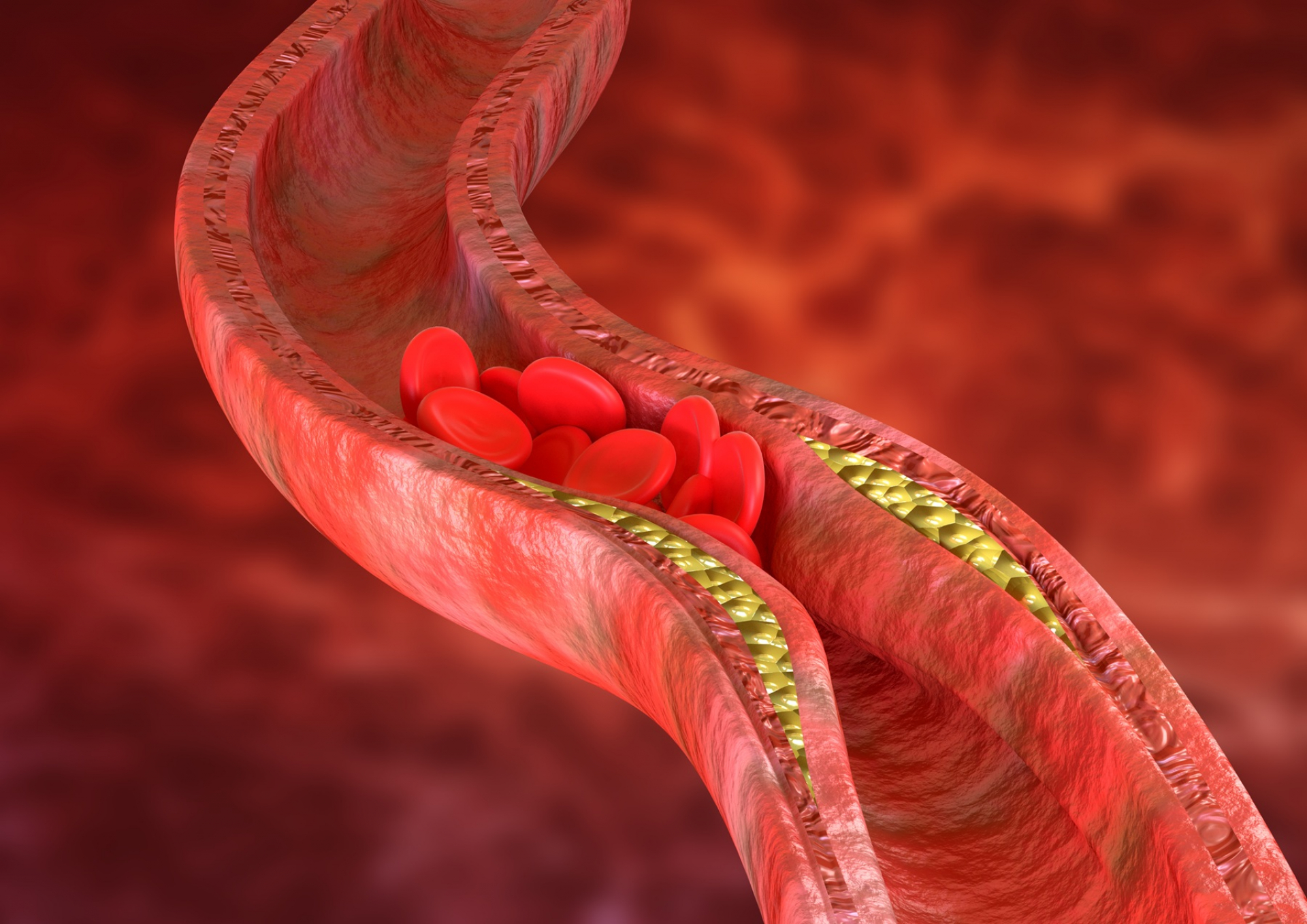 how-to-know-the-symptoms-of-high-lipoprotein-a-warning-signs-and-risk-factors