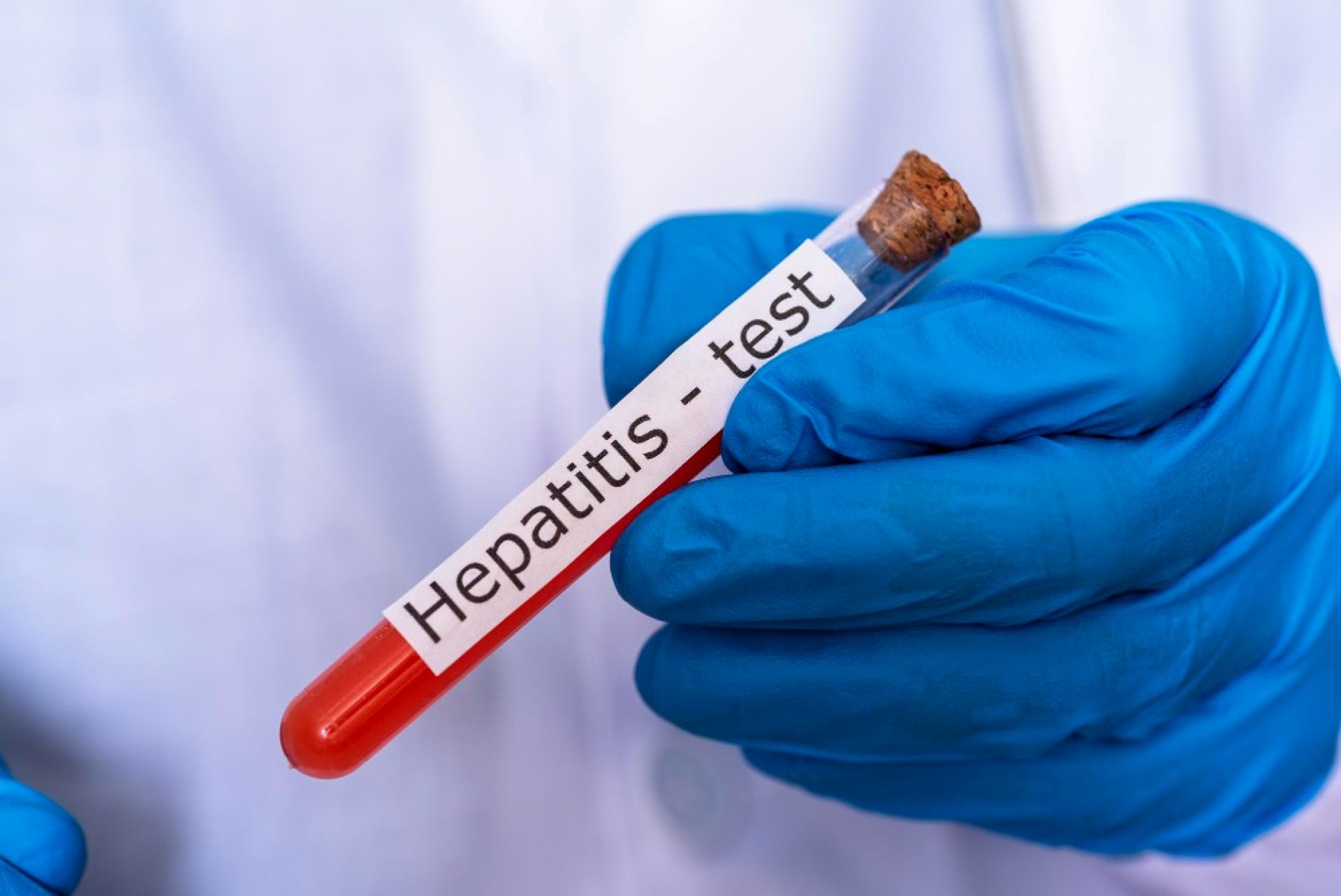 hepatitis-screening-when-liver-tests-aren-t-enough-to-detect-silent-infection