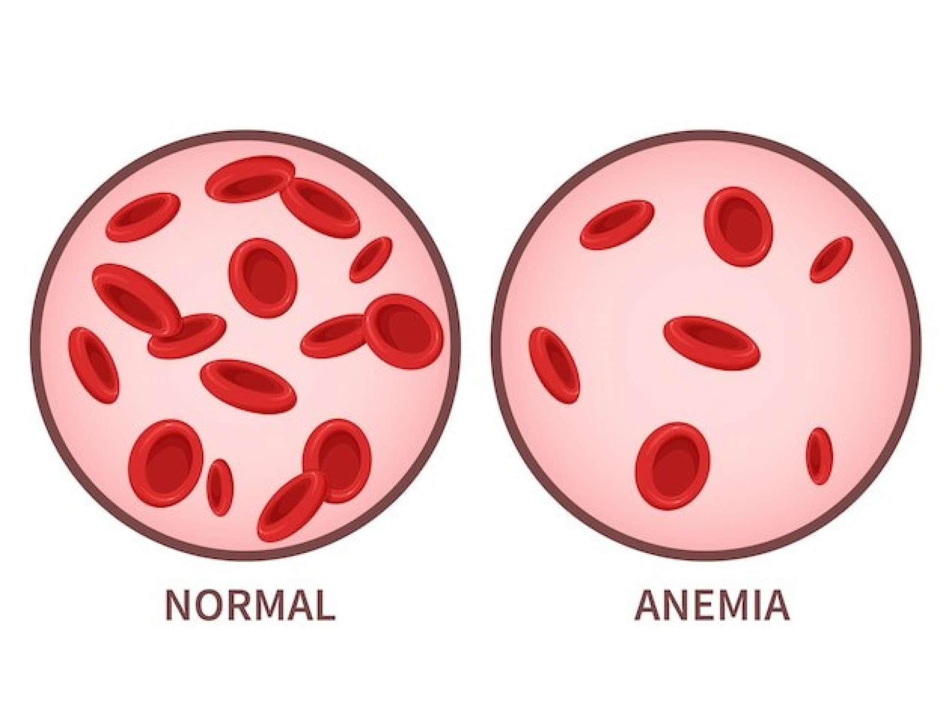 high-tibc-levels-causes-symptoms-and-treatment-options