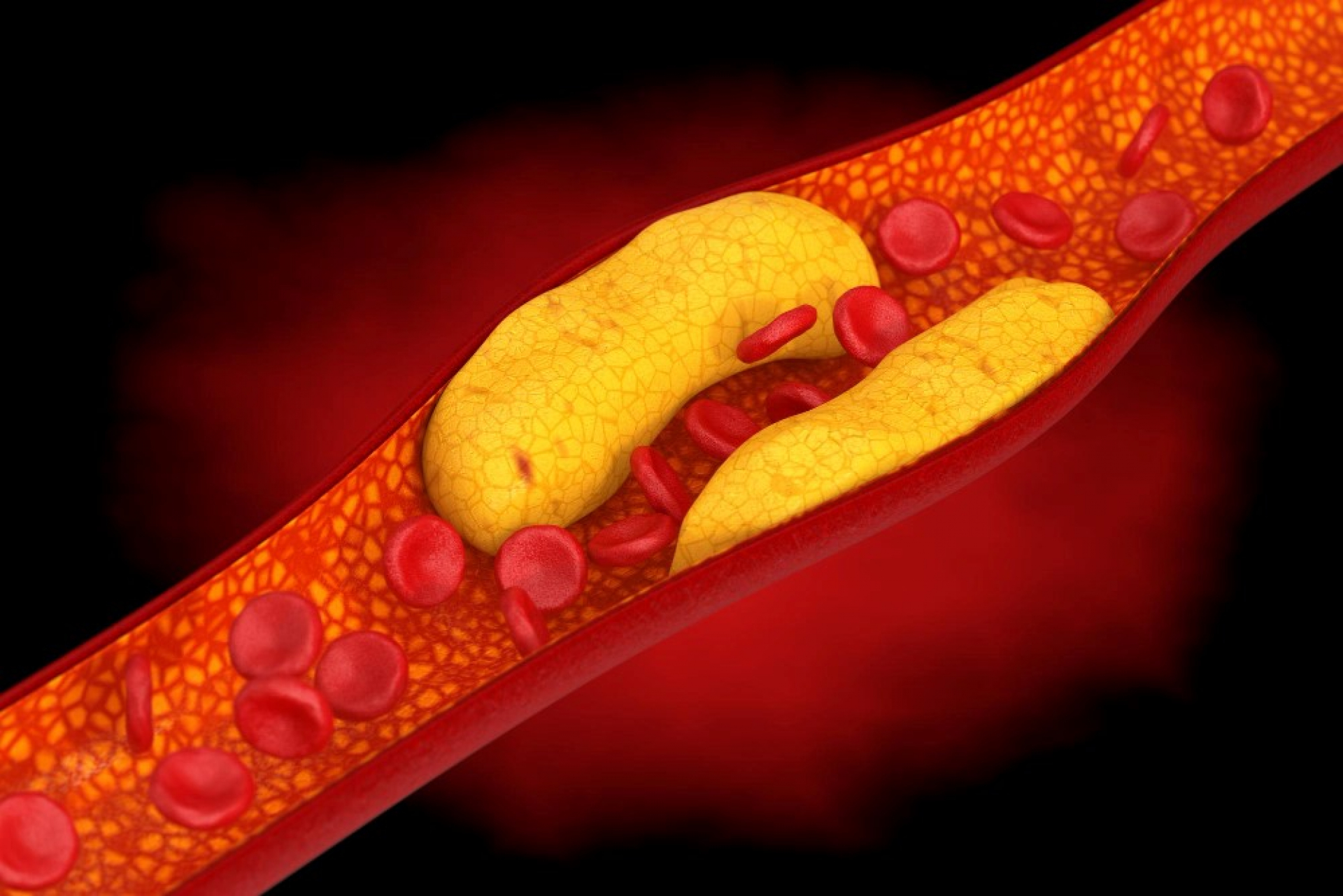 understanding-atherosclerosis-and-plaque-build-up-cholesterol-levels-lipid-profile-and-your-heart-disease-risk